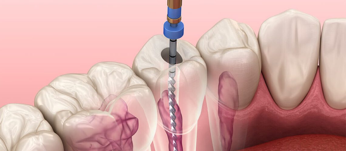 root-canal-infection-symptoms-tucson-az